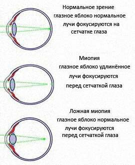 близорукость картинка