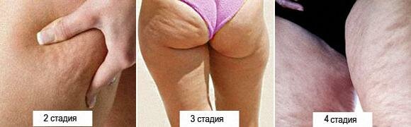 стадии целлюлита фото